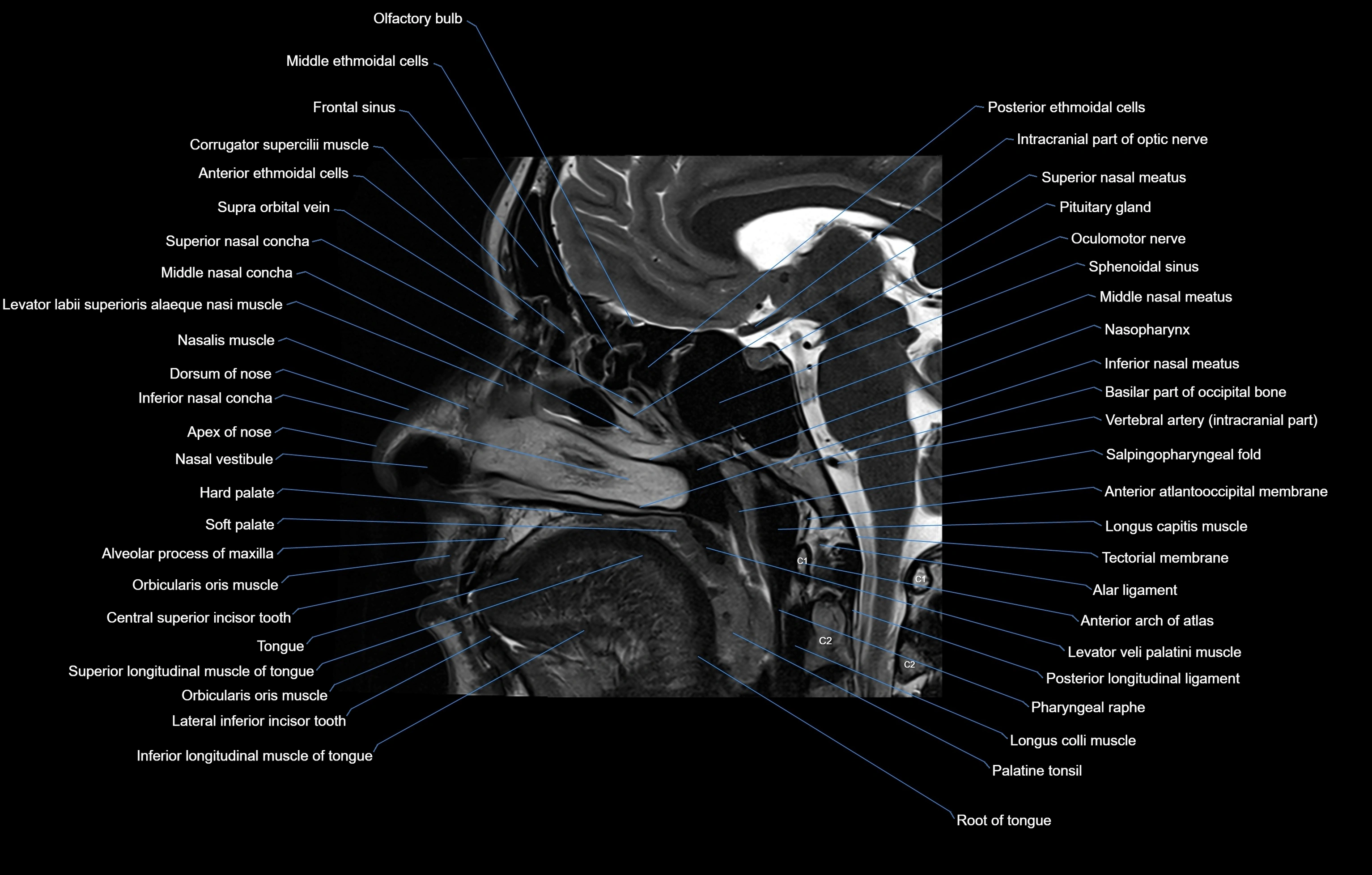 paranasal sinuses(PNS) MRI coronal  cross sectional anatomy 3T radiology  image-img-00001-00005.webp